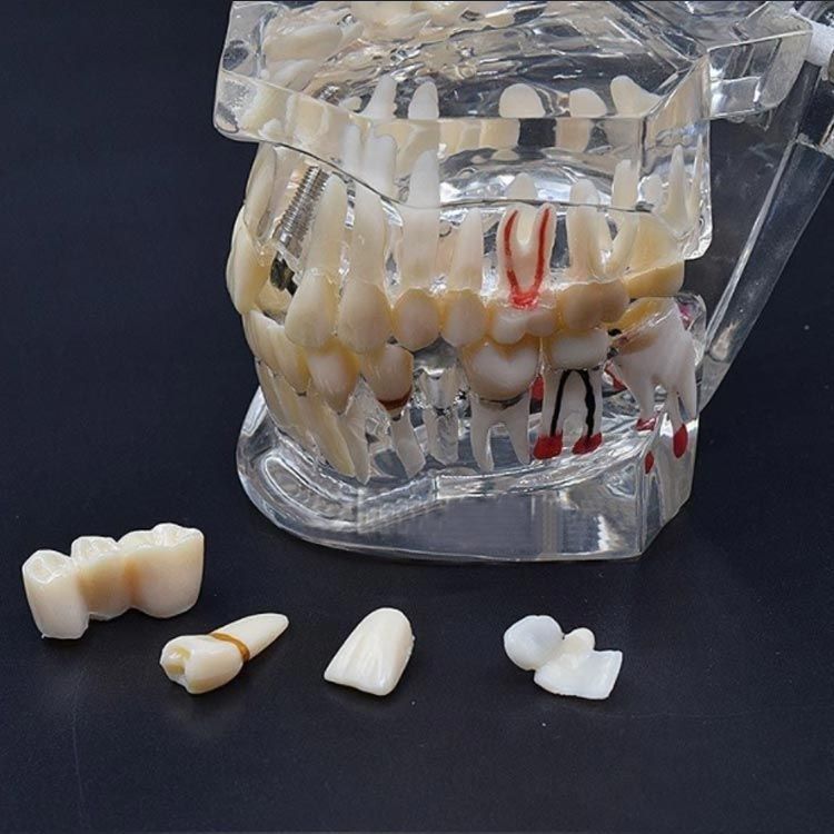 歯模型 透明 歯の模型 歯列模型 疾患展示模型 歯科模型 差し歯 歯医者