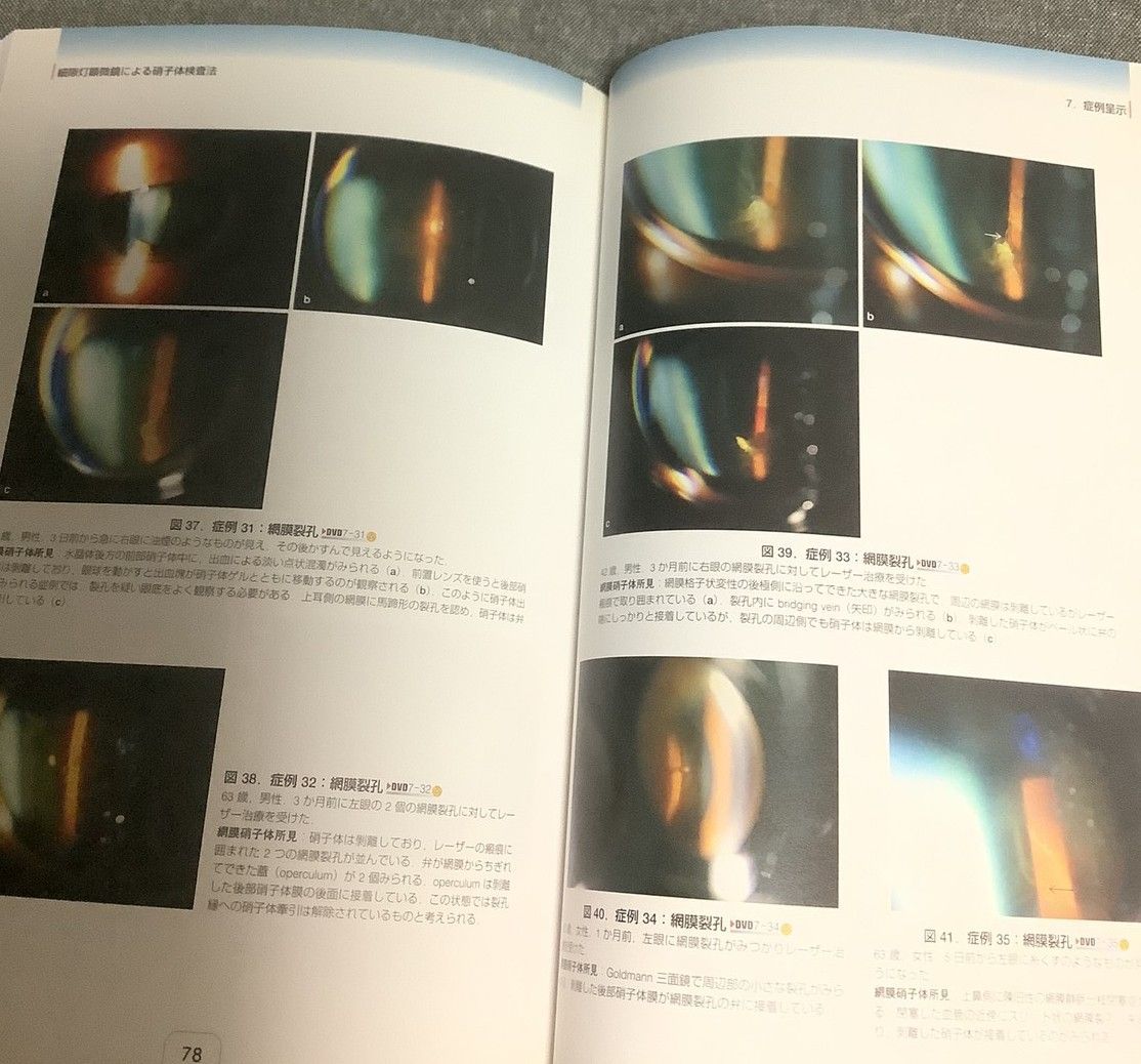 細隙灯顕微鏡による硝子体検査法 後部硝子体剥離の診断 梯 彰弘 細隙灯顕微鏡による硝子体検査法 後部硝子体剥離の診断 梯 彰弘